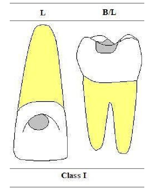 اصطلاحات دندانپزشکی در تقسیم بندی پوسیدگی ها