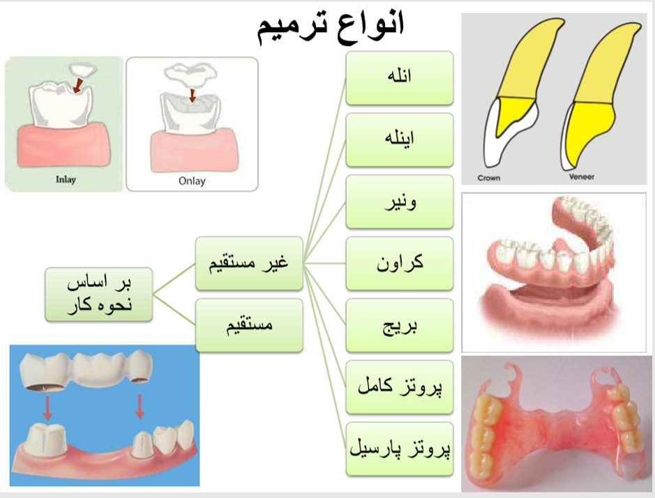 اصطلاحات دندانپزشکی در انواع ترمیم