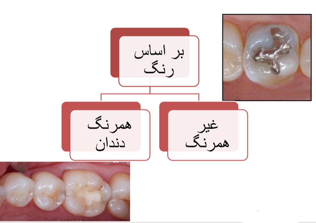 اصطلاحات دندانپزشکی ترمیمی
