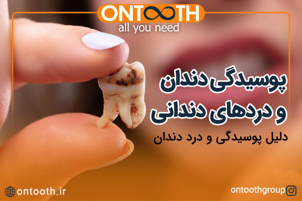 پوسیدگی دندان و دردهای دندانی