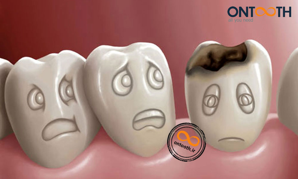 پوسیدگی دندان چیست و دردهای دندانی