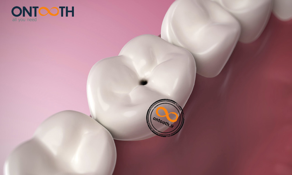 پوسیدگی دندان و دلیل دردهای دندانی