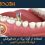 استفاده از گوتا پرکا در دندانپزشکی