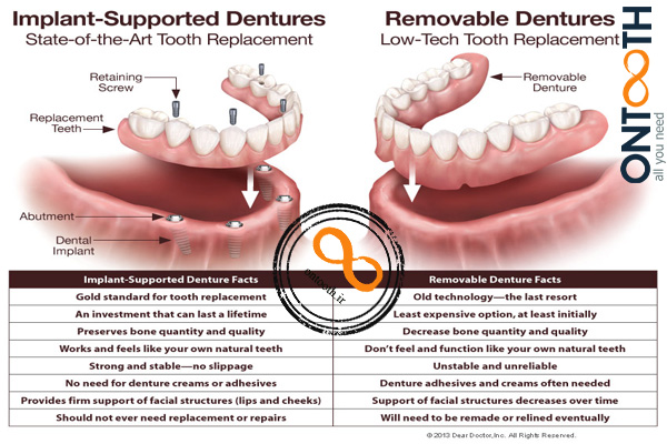 تفاوت دندان مصنوعی با اوردنچر چیست