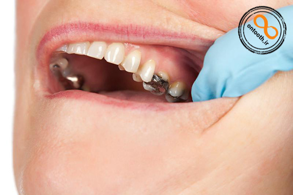 تصویر پر کردن دندان با مواد سیاه