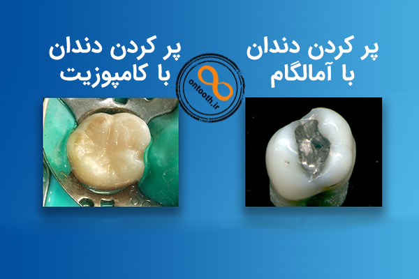 پرکردن دندان با مواد سیاه یا آمالگام در برابر کامپوزیت