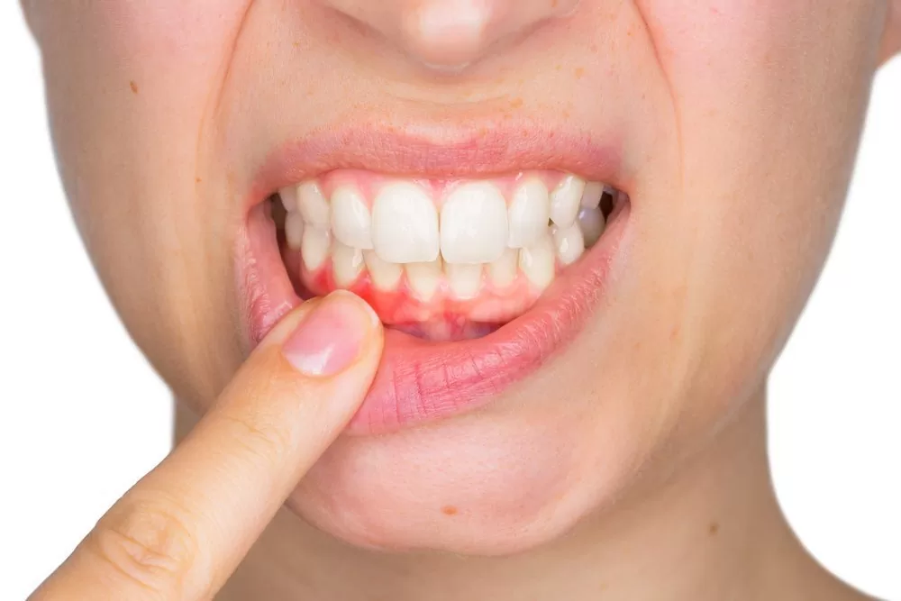 قوی ترین چرک خشک کن دندان و جدول پروفیلاکسی آنتی بیوتیک در دندانپزشکی