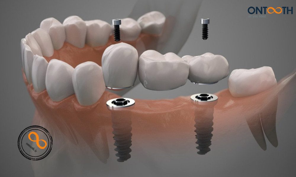 ایمپلنت دیجیتال و پایه های دندان